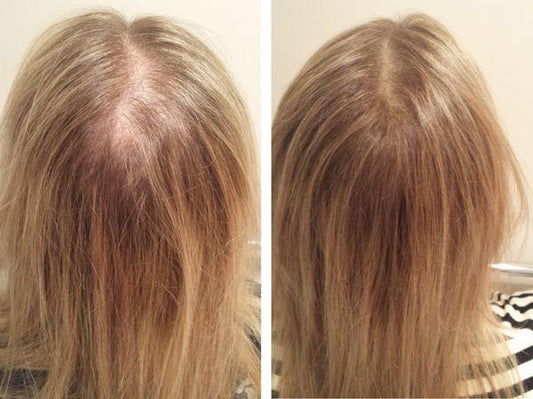 Why Is My Hair Thinning? (And What Actually Works to Fix It) - Shelley and Co