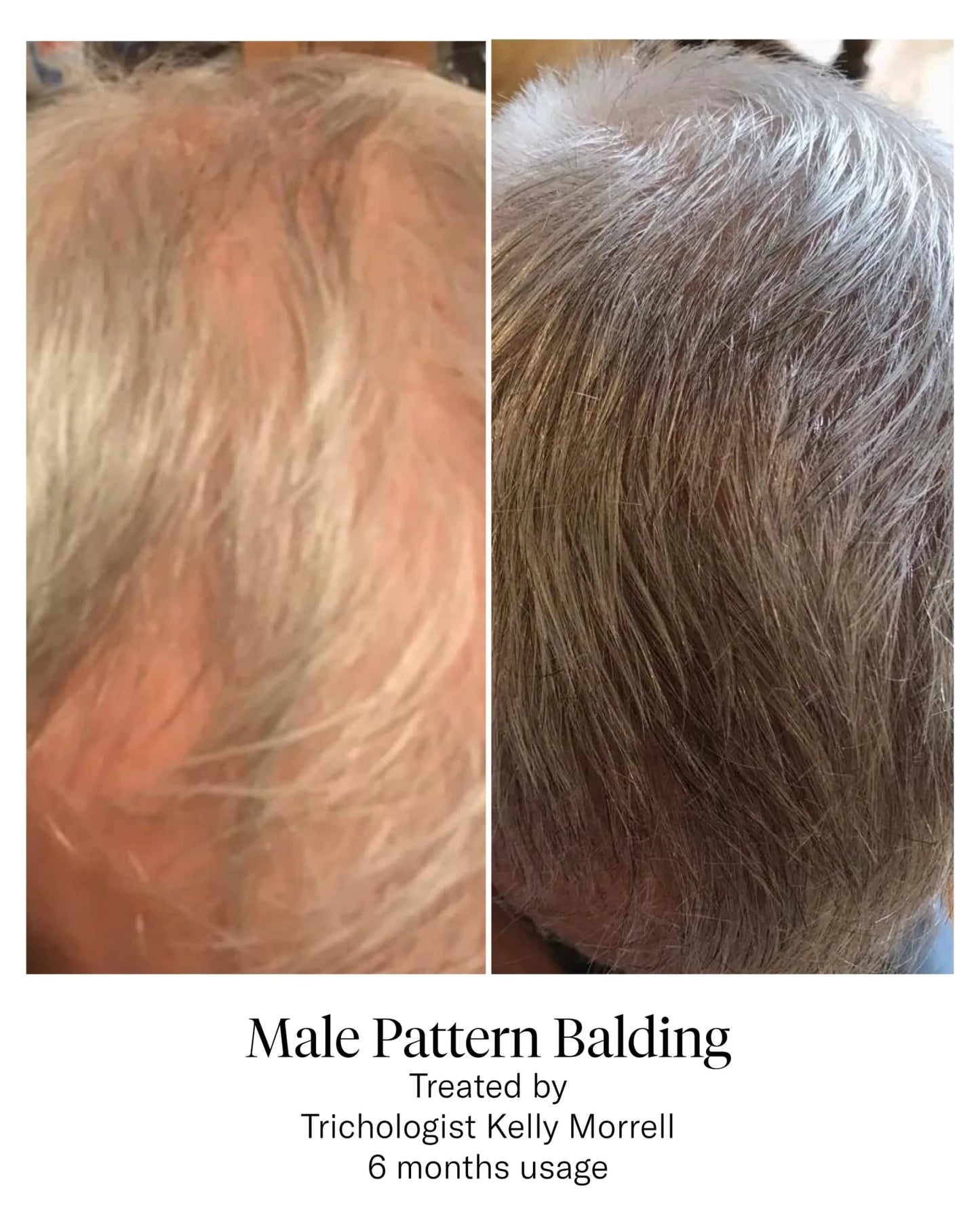 Calecim Professional Advanced Hair System - Shelley and Co