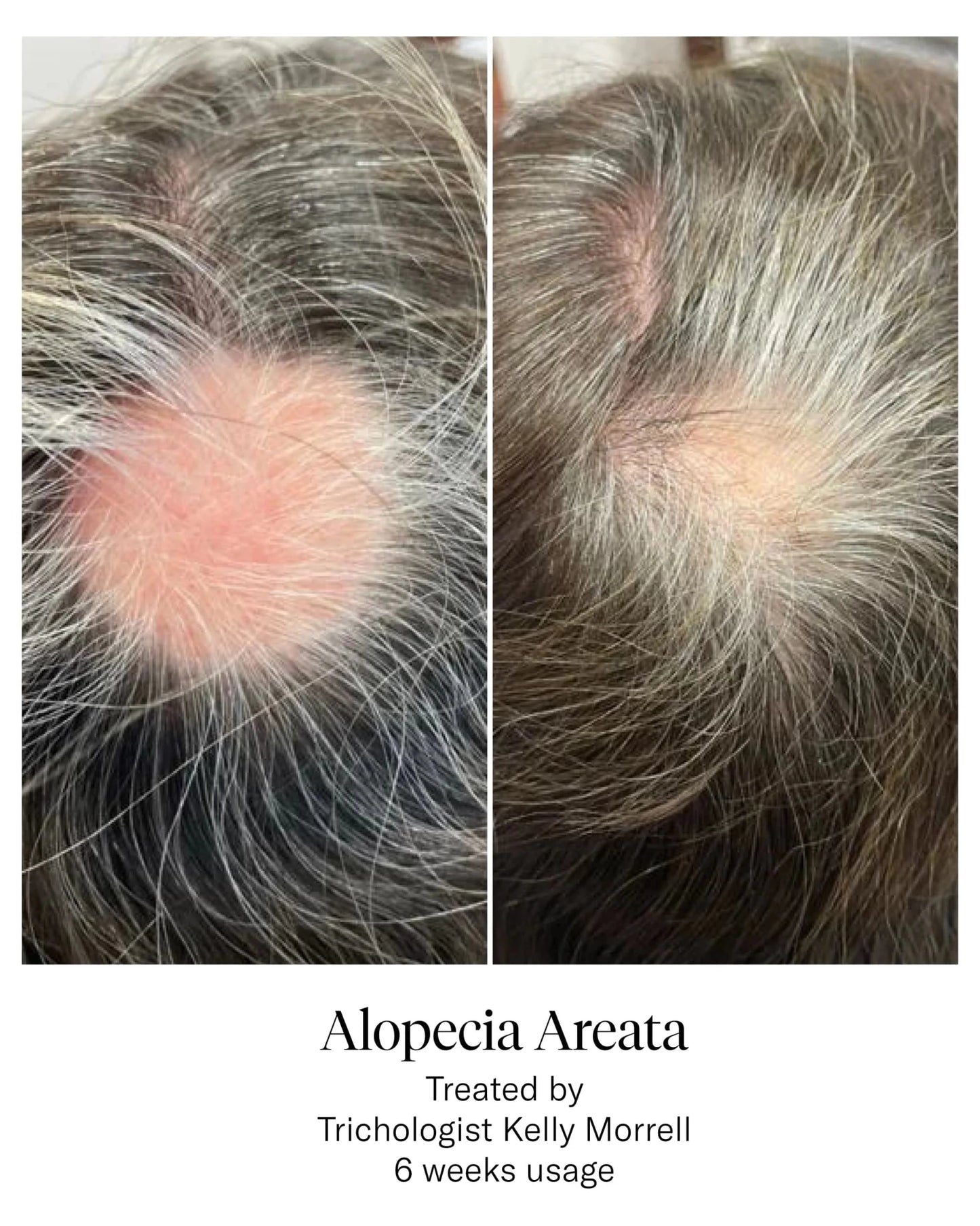 Calecim Professional Advanced Hair System - Shelley and Co