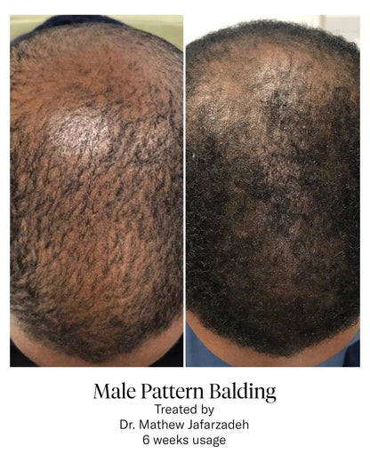 Calecim Professional Advanced Hair System - Shelley and Co