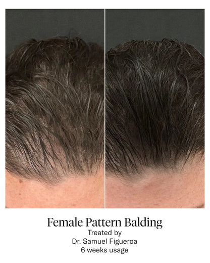 Calecim Professional Advanced Hair System - Shelley and Co