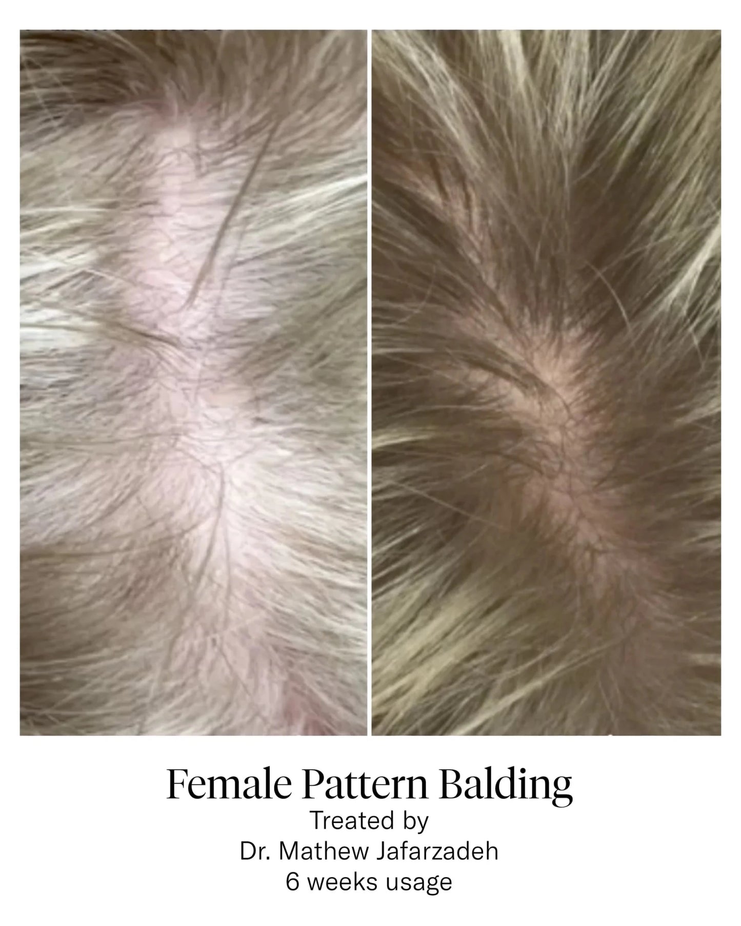 Calecim Professional Advanced Hair System - Shelley and Co